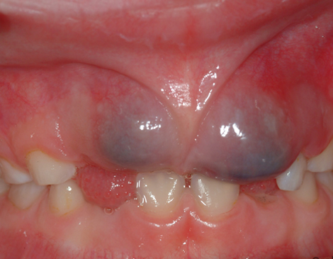 teeth eruption