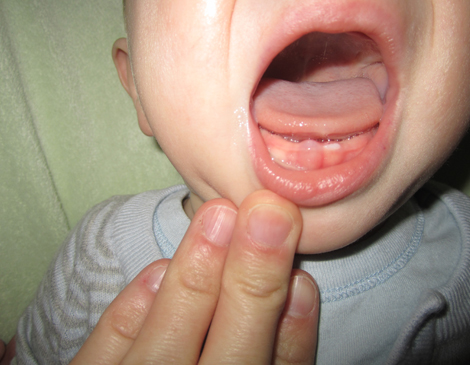 teeth eruption